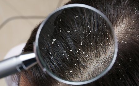 How To Get Rid Of Dandruff With 5 Simple Steps?