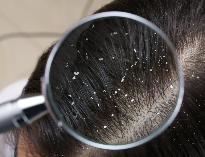 How To Get Rid Of Dandruff With 5 Simple Steps?