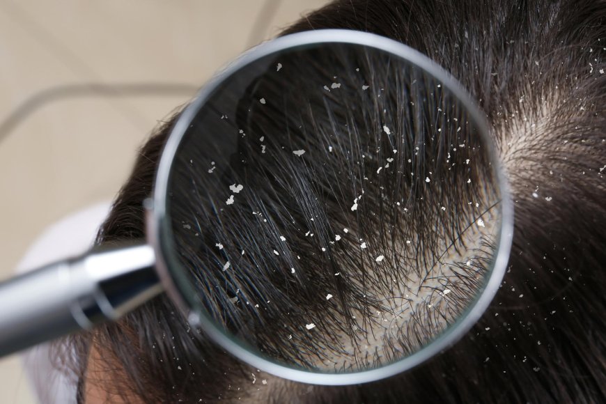 How To Get Rid Of Dandruff With 5 Simple Steps?